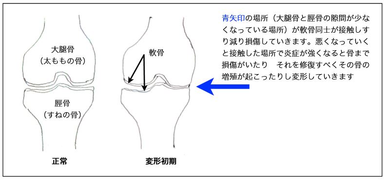 膝変形の説明