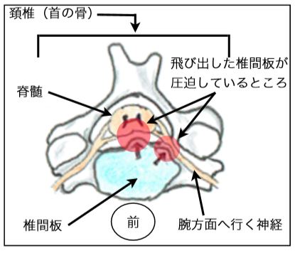 頸椎椎間板ヘルニアの図