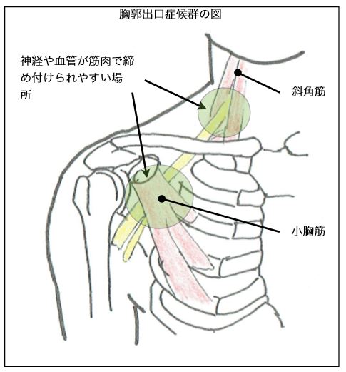 胸郭出口症候群の図