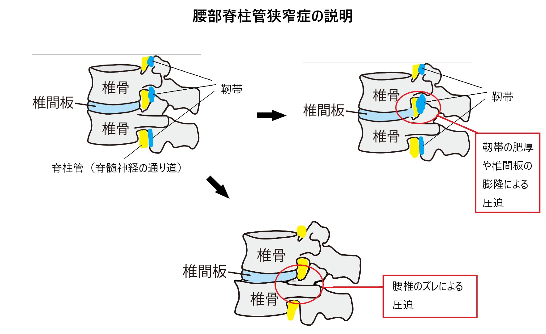 腰部脊柱管狭窄症の説明